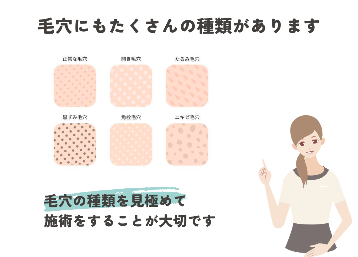 お客様の毛穴の種類を見極めて施術をすることが大切